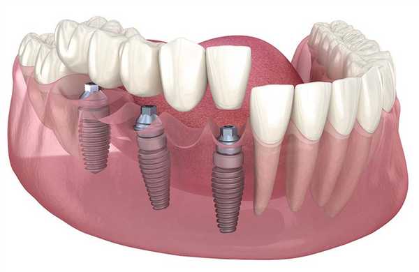 Моста на имплантах при отсутствии 5 и более зубов подряд