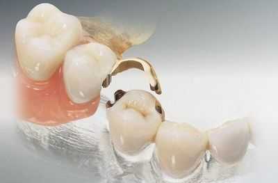 Условно-съемный мостовидный протез