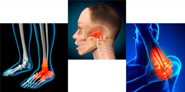 Виды реактивного артрита по локализации