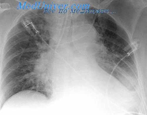 бронхоспирометрия