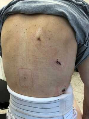 Вид послеоперационных ран после торакоскопии