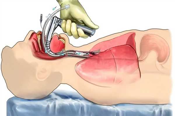 Вентиляция легких при торакоскопии