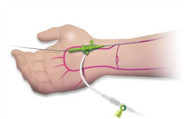 Лучевой доступ - доступ выбора для аортографии в Инновационном сосудистом центре