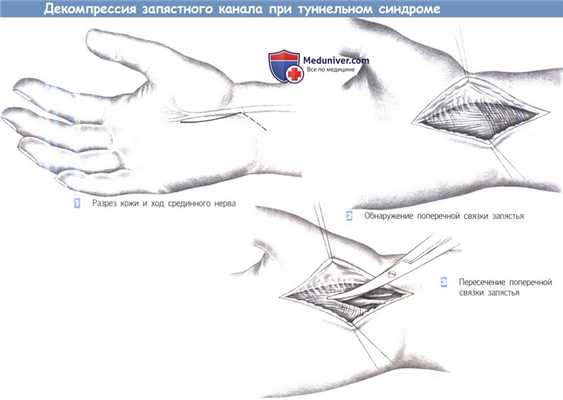 Декомпрессия запястного канала при туннельном синдроме