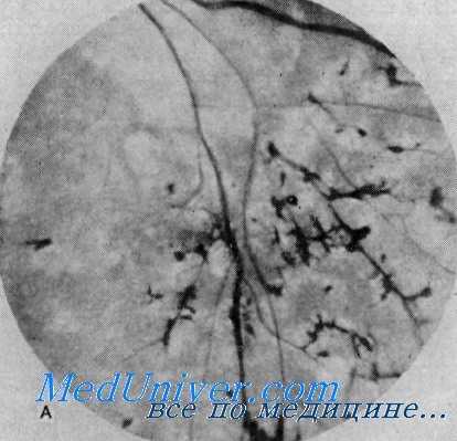 пигментный ретинит - синдром ушера