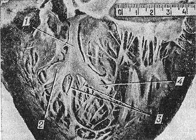 Рис. 2. Макропрепарат сердца с отпрепарированной левой ножкой пучка Гиса
