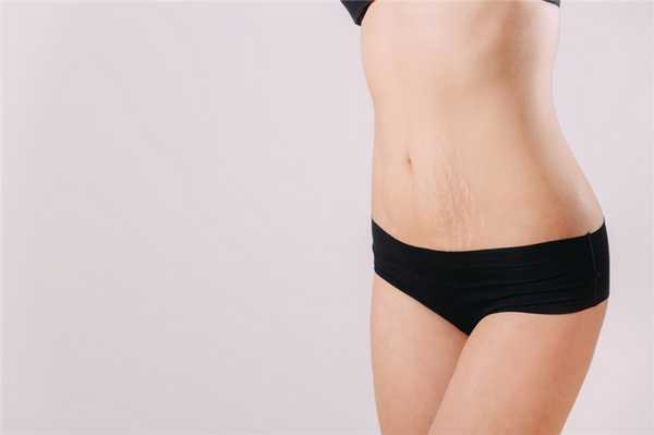 Как избежать появления растяжек?