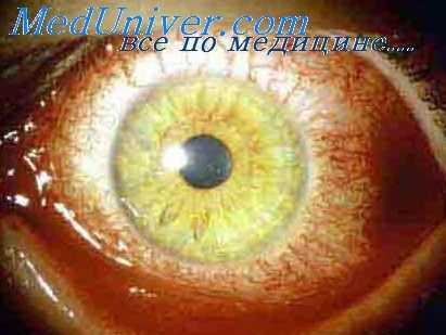 аллергии органа зрения