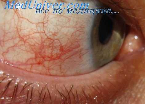 реакции в офтальмологии