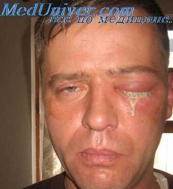 аллергены в офтальмологии