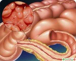 заболевание жкт симптомы