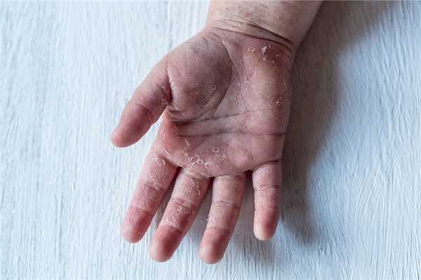 Отшелушивание кожи на ладонях.jpg