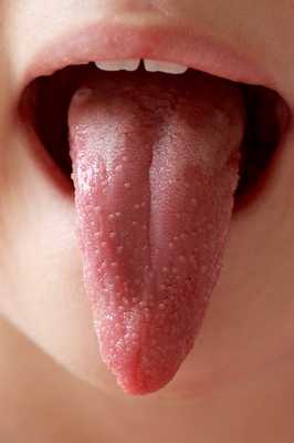 Язык при скарлатине.jpg