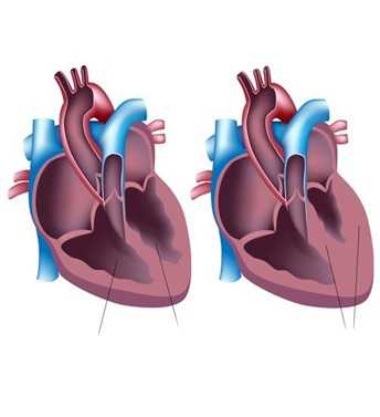 Фото Гипертрофия миокарда левого желудочка