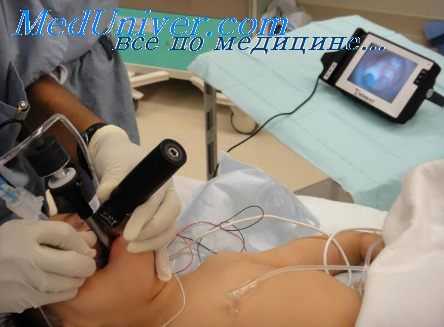 прямая ларингоскопия