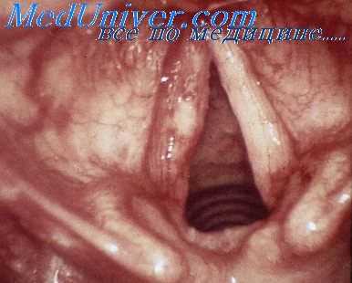 ларингоскопия