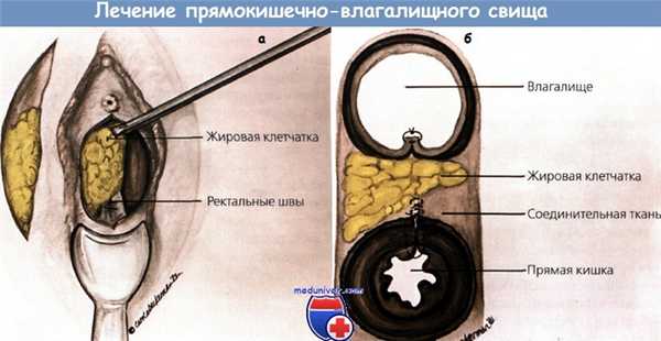 Лечение прямокишечно-влагалищного свища