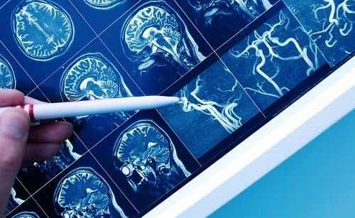 КТ сосудов мозга с контрастом