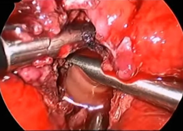 Лапароскопическое дренирование абсцесса поджелудочной железы с некрэктомией.
