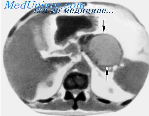 псевдокиста поджелудочной железы