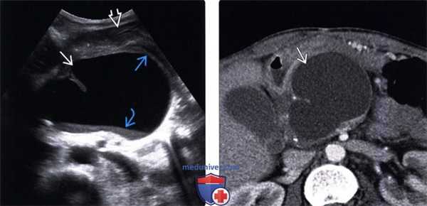 УЗИ, КТ при псевдокисте поджелудочной железы