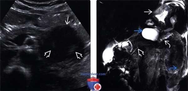 УЗИ, МР холангиопанкреатография при псевдокисте поджелудочной железы