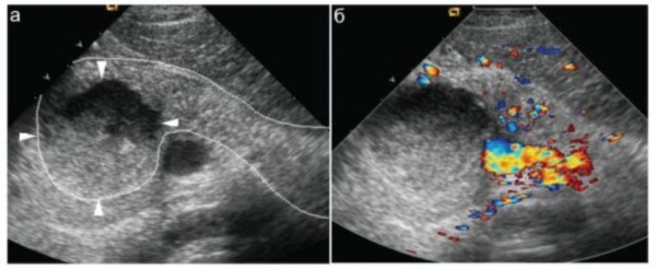 УЗИ поджелудочной железы. На фоне резкого увеличения размеров железы (обведена пунктиром) в ее головке определяется крупный (до 3 см в диаметре) абсцесс (показан стрелками).
