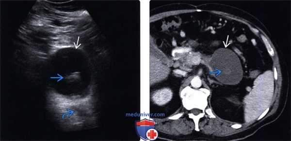 УЗИ, КТ при псевдокисте поджелудочной железы