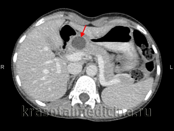 Киста поджелудочной железы