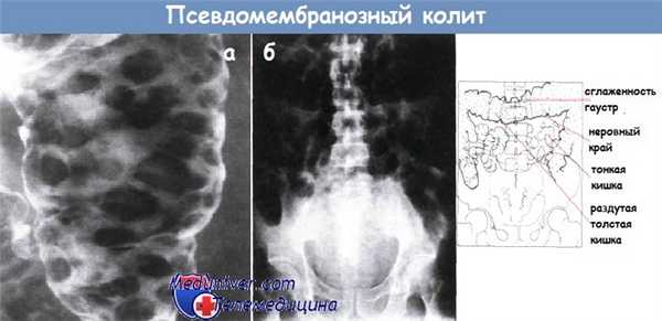 Псевдомембранозный колит