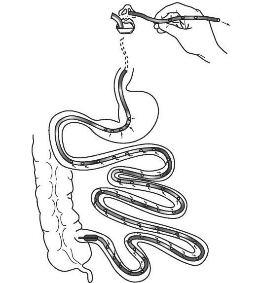 Назоинтестинальный зонд