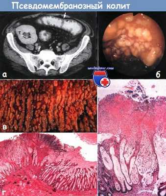 Псевдомембранозный колит