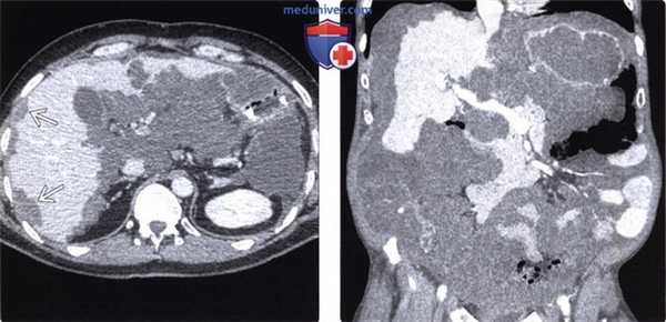 КТ, МРТ, УЗИ при псевдомиксоме брюшины