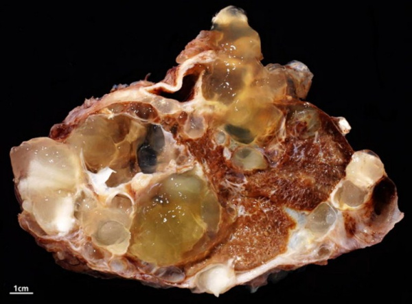 Опухоли брюшины