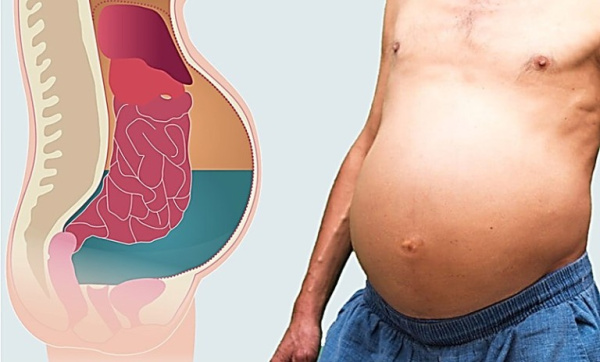 Опухоли брюшины