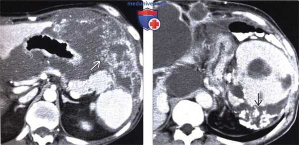 КТ, МРТ, УЗИ при псевдомиксоме брюшины