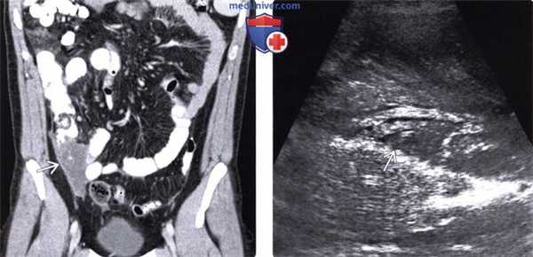 КТ, МРТ, УЗИ при псевдомиксоме брюшины