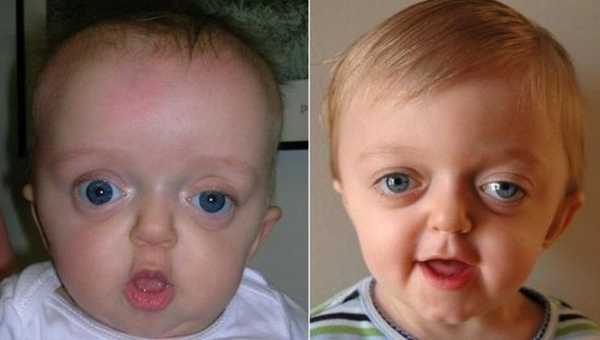 Синдром Крузона Жесть, Медицина, Синдром, Длиннопост