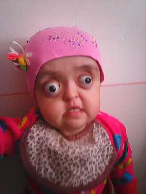 Синдром Крузона Жесть, Медицина, Синдром, Длиннопост