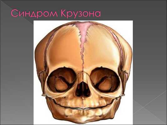 Череп при синдроме Крузона