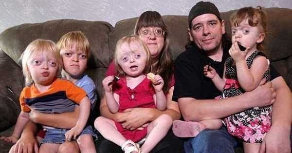 Синдром Крузона Жесть, Медицина, Синдром, Длиннопост