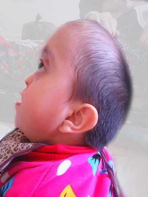 Синдром Крузона Жесть, Медицина, Синдром, Длиннопост