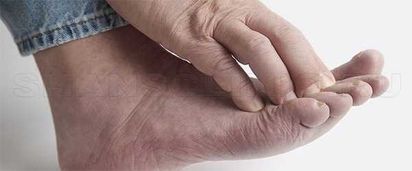 Полинейропатия стопы и кисти руки