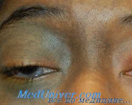 Ретиношизис