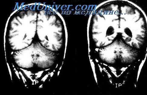 диагностика шизофрении