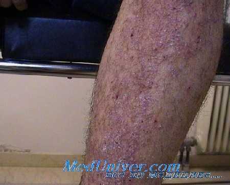 лечение нейродермита