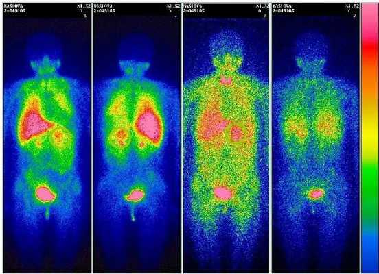 Cцинтиграфия 123I-МИБГ