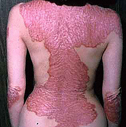 глубокие поражения псориазом