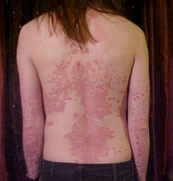 псориаз диссеминированный