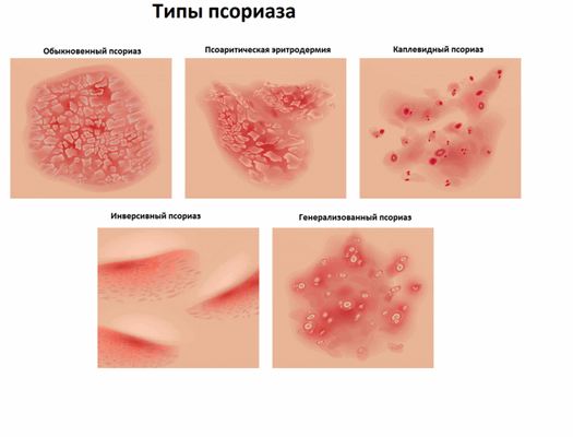 типы псораза.png